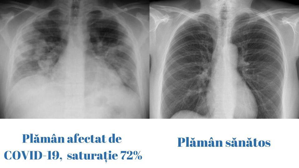 Cum arată plămânul unui tânăr de 23 de ani cu COVID, faţă de un plămân sănătos