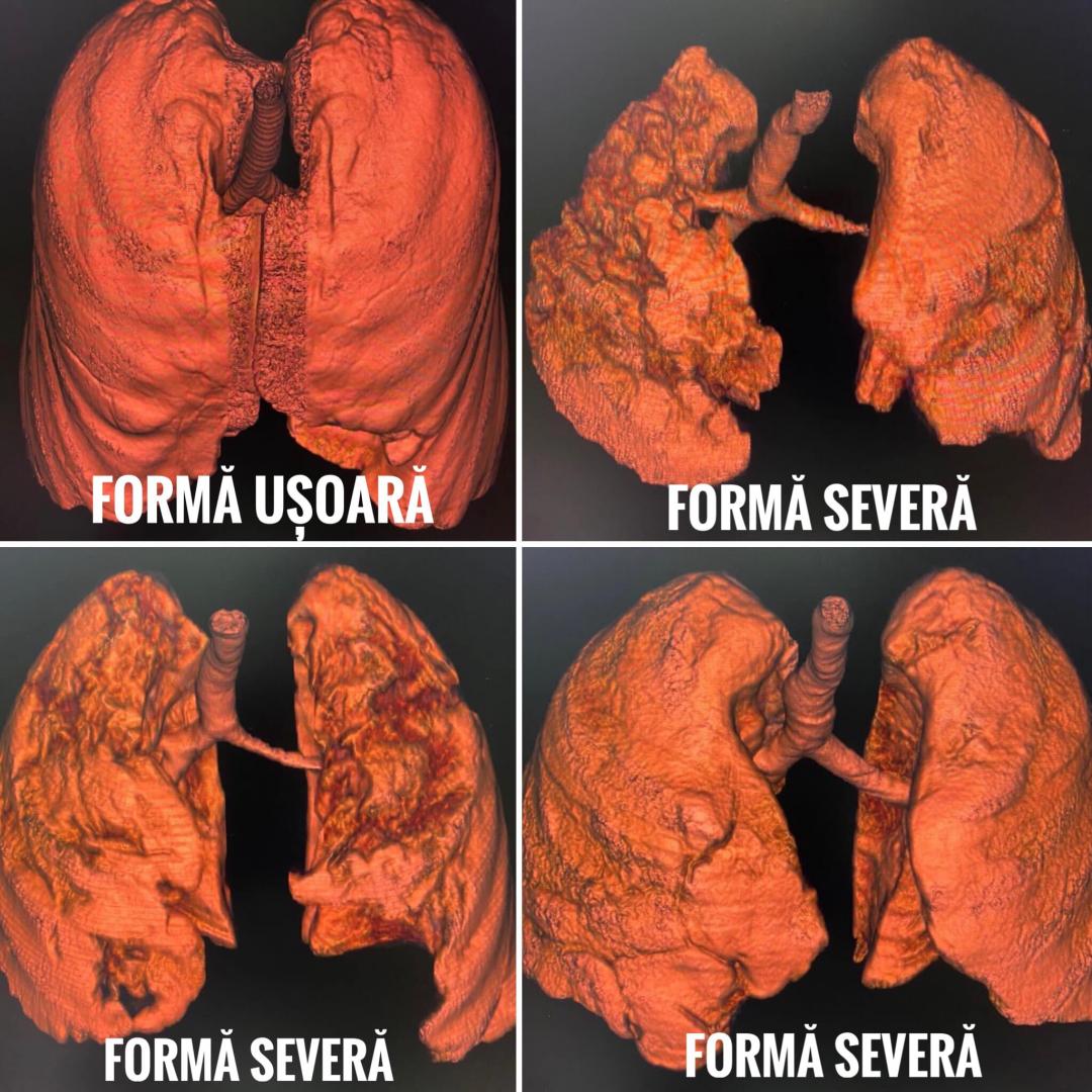 CNCAV a publicat tomografiile computerizate a unor pacienţi cu COVID, nevaccinaţi: „Nu vă jucaţi cu sănătatea!"