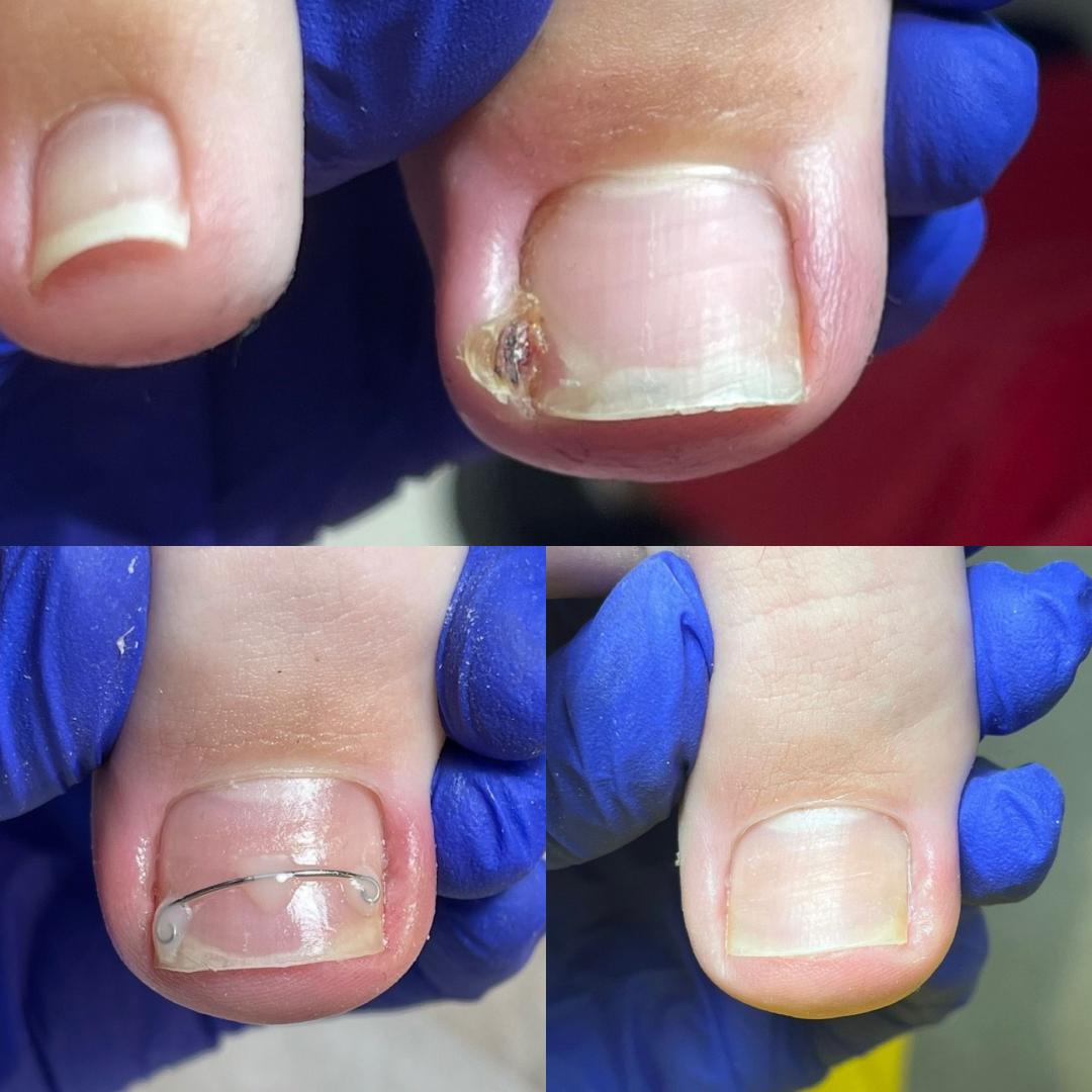 &bdquo;Nu tăiați colțurile unghiilor de la picioare, &icirc;n special la copii!''. Cum se rezolvă unghiile &icirc;ncarnate fără durere, la Antoaneta Tulbure Studio