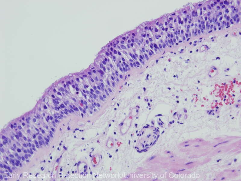 O tehnologie spaţială va fi folosită pentru a accelera diagnosticarea cancerului intestinal