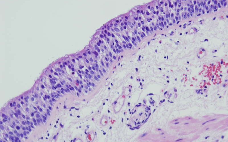 O tehnologie spaţială va fi folosită pentru a accelera diagnosticarea cancerului intestinal