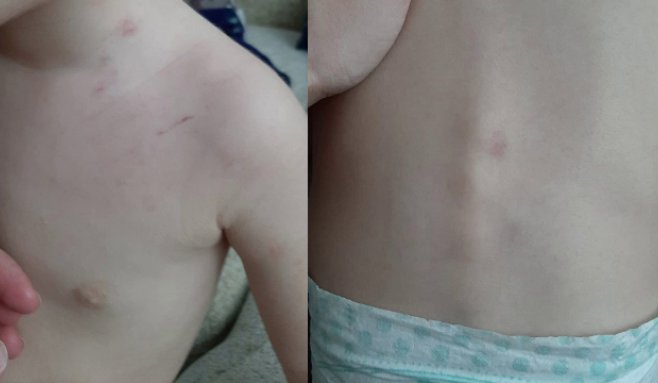 Scandal la o creșă din Cluj. O mămică și-a adus copilul acasă plin de vânătăi