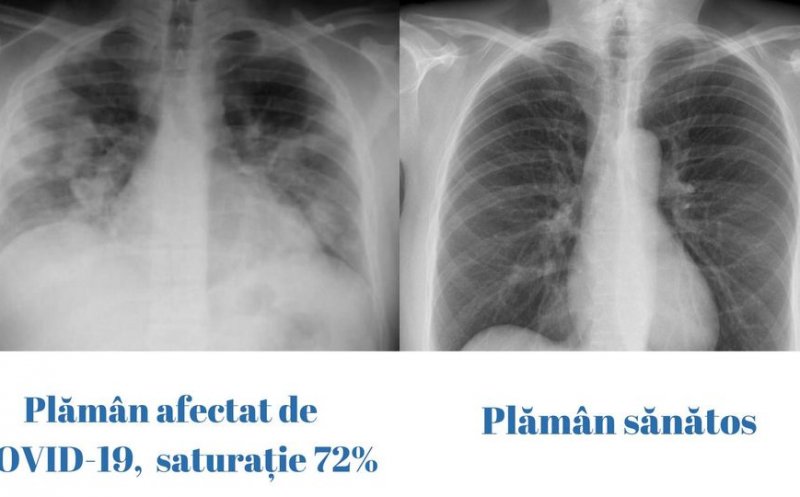 Cum arată plămânul unui tânăr de 23 de ani cu COVID, faţă de un plămân sănătos