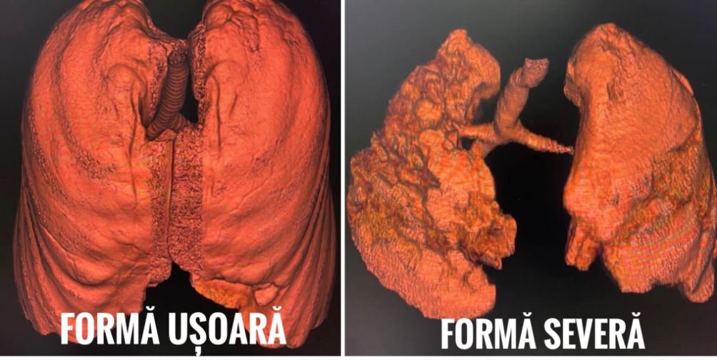 CNCAV a publicat tomografiile computerizate a unor pacienţi cu COVID, nevaccinaţi: „Nu vă jucaţi cu sănătatea!"