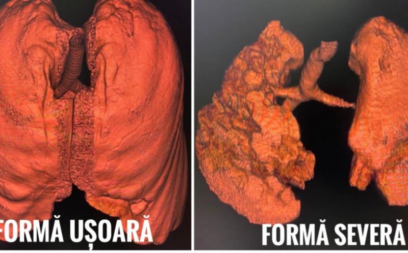 CNCAV a publicat tomografiile computerizate a unor pacienţi cu COVID, nevaccinaţi: „Nu vă jucaţi cu sănătatea!"