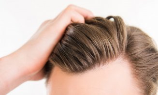 Cât costă la Cluj implantul de păr, noua tendinţă care completează look-ul bărbaţilor
