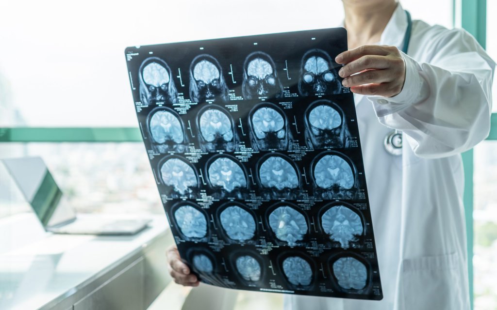Vești bune! Un medicament experimental a dat rezultate în tratarea Alzheimer