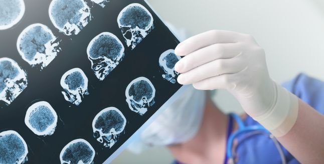 Cercetători: Creierele adolescenților care au avut COVID prezintă semne de îmbătrânire accelerată