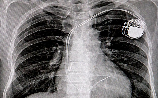 Reţeaua lui Tesloianu prescria medicamente care să provoace necesitatea implantării unui stimulator cardiac