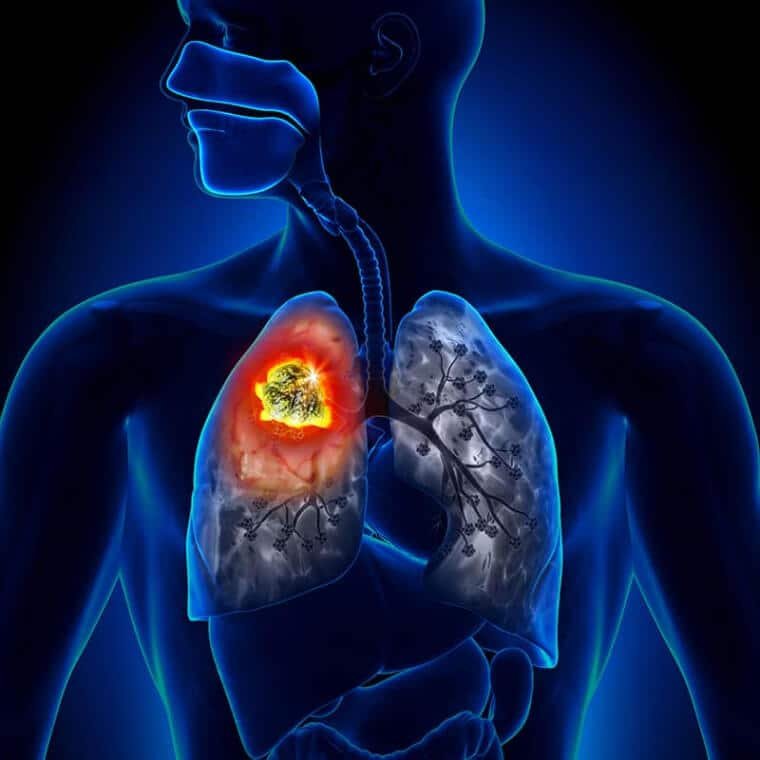 Ziua Mondială de Luptă Împotriva Cancerului Pulmonar. Principalii factori de risc și cine are indicație de screening pulmonar