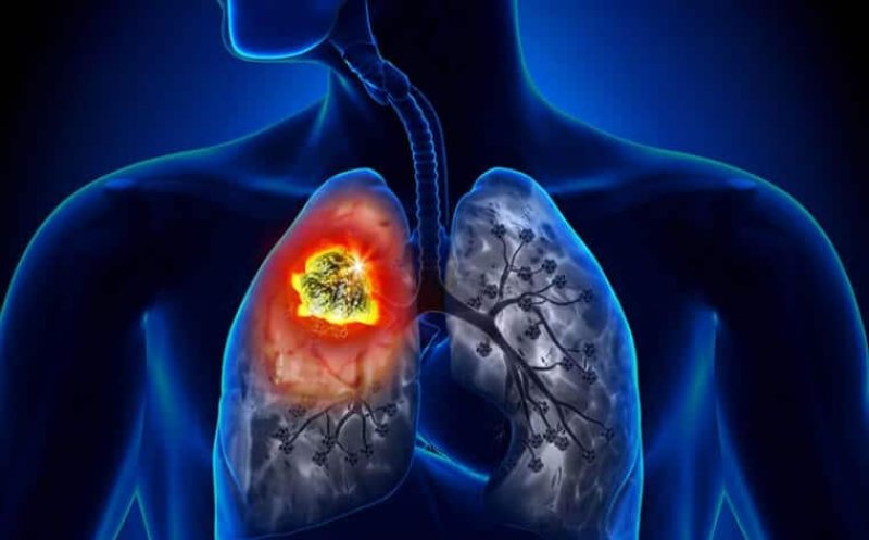 Ziua Mondială de Luptă Împotriva Cancerului Pulmonar. Principalii factori de risc și cine are indicație de screening pulmonar