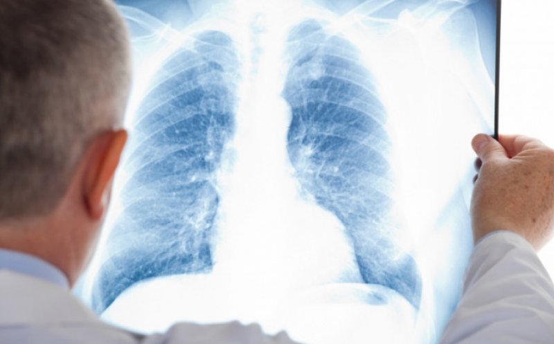 Atenţionarea pneumologilor: un bărbat din 15 riscă să fie diagnosticat cu cancer pulmonar, până la 75 de ani