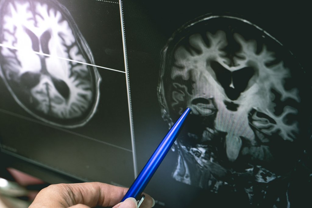 Ziua Internațională Alzheimer: Peste 7.900 de cazuri noi în România, înregistrate doar anul trecut/ Semnele și simptomele timpurii ale bolii