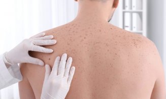 Avertismentul unui medic chirurg: Cancerele de piele sunt din ce în ce mai frecvente. Nu mai sunt oamenii atât de sănătoşi