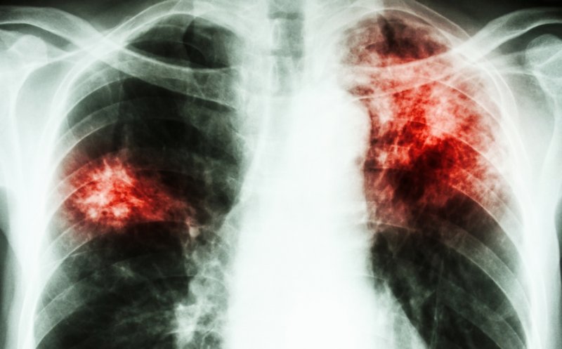 România, prima în UE la incidența cazurilor de tuberculoză. Rafila: "Observăm şi o suprapunere a situaţiei legate de poluare"