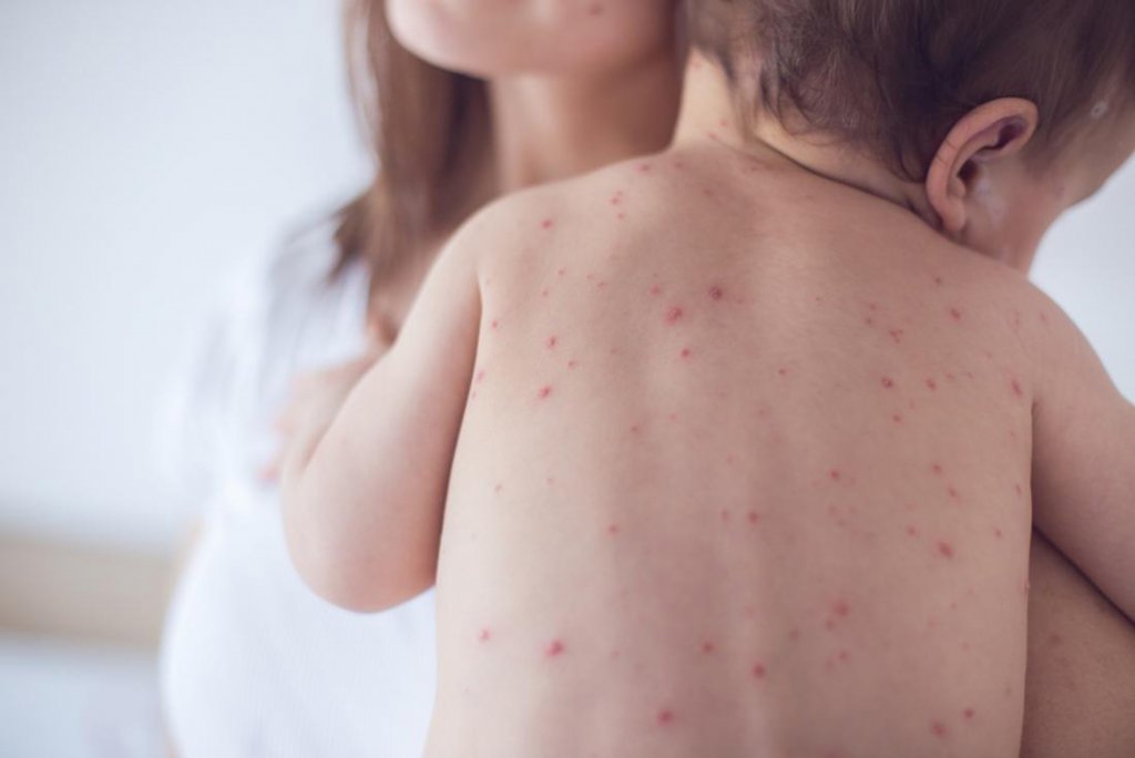 Un copil de doi ani nevaccinat a murit de rujeolă