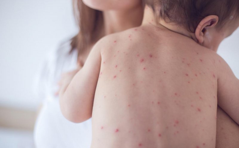 Un copil de doi ani nevaccinat a murit de rujeolă