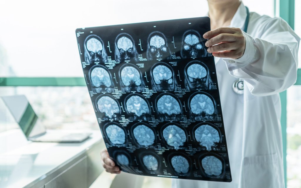 Un nou test poate prognoza evoluția pe cinci ani pentru pacienții semne incipiente de Alzheimer