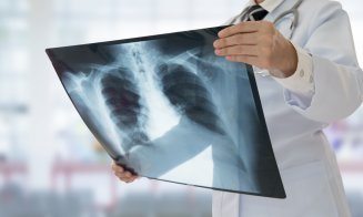 Avertismentul unui medic: Datele arată că 1 din 16 oameni va fi diagnosticat cu cancer pulmonar/ Care sunt principalii factori de risc