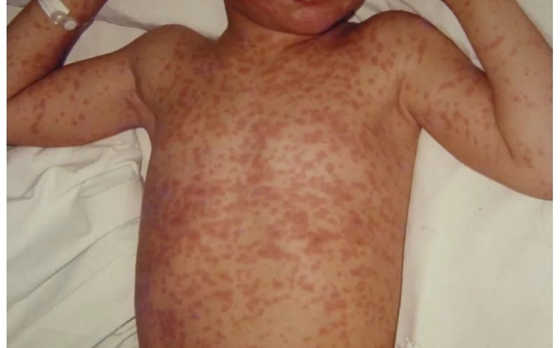 Alarmant! 30 de decese și aproape 36.000 de cazuri cu rujeolă înregistrate în România. Cele mai multe infectări, la cei nevaccinați