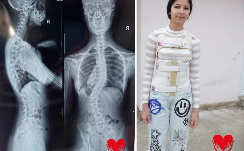 „Fiecare zi îmi curbează coloana tot mai mult”. Erika, o adolescentă de 15 ani, are nevoie urgent de o operație pentru a putea trăi fără durere