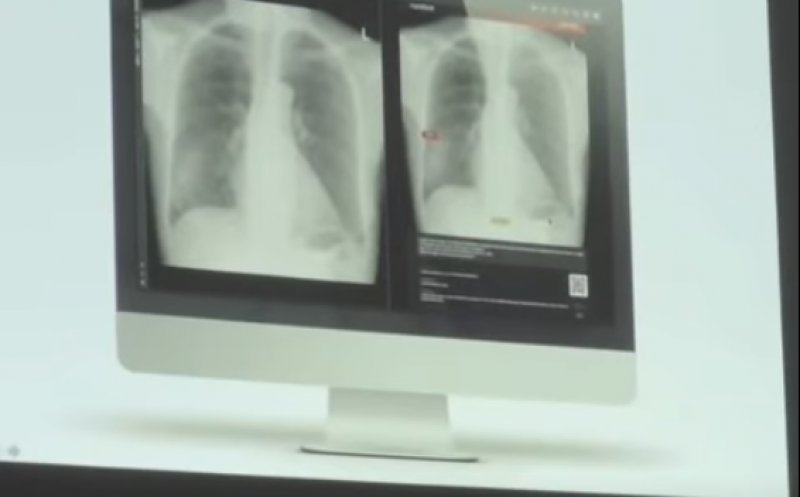 Tehnologie de ultimă oră la Spitalul Județean Cluj. Cancerul pulmonar, despistat cu AI
