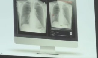 Tehnologie de ultimă oră la SCJU Cluj. Inteligența artificială ajută la detectarea cancerului pulmonar