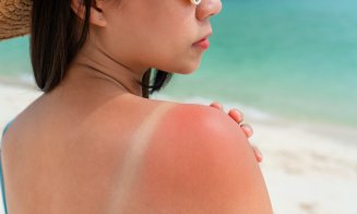 Arsurile solare din copilărie pot lăsa urme pe viață. Riscul de cancer de piele poate fi de până la 3 ori mai mare